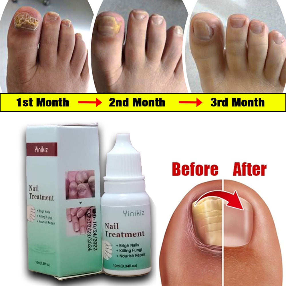 Nail Fungus Remover (100 % Cash Back Guarantee)