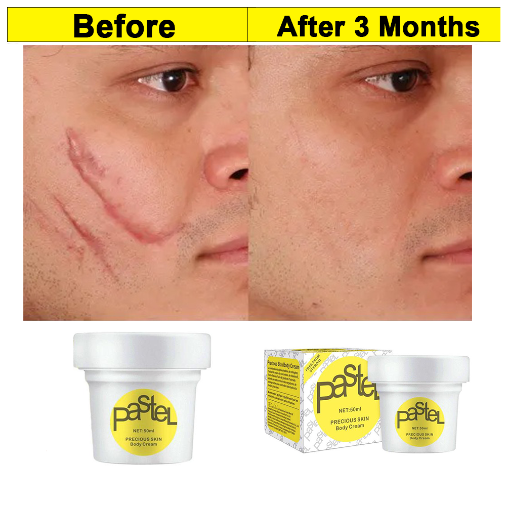 ✅दाग ,धर्सा १००% ग्यारन्टीको साथ हटाउने क्रिम Pastel Mark Repair Cream 50ml